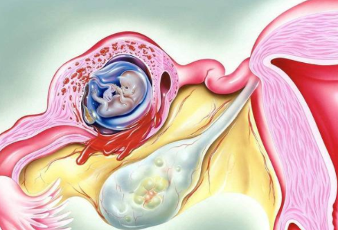 菏泽44岁助孕：怀孕期间的绒毛膜癌能治愈吗，怀孕期间要注意什么？
